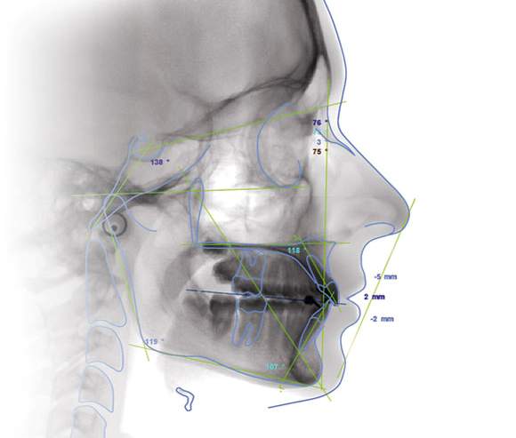 Planmeca Romexis cephalometric analysis module