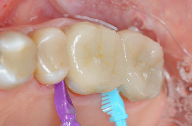Fitting and cementation