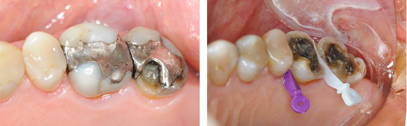 Preparation and intraoral scanning