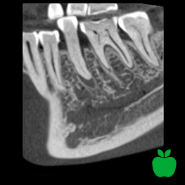 Planmeca HD resolution with ultra low dose