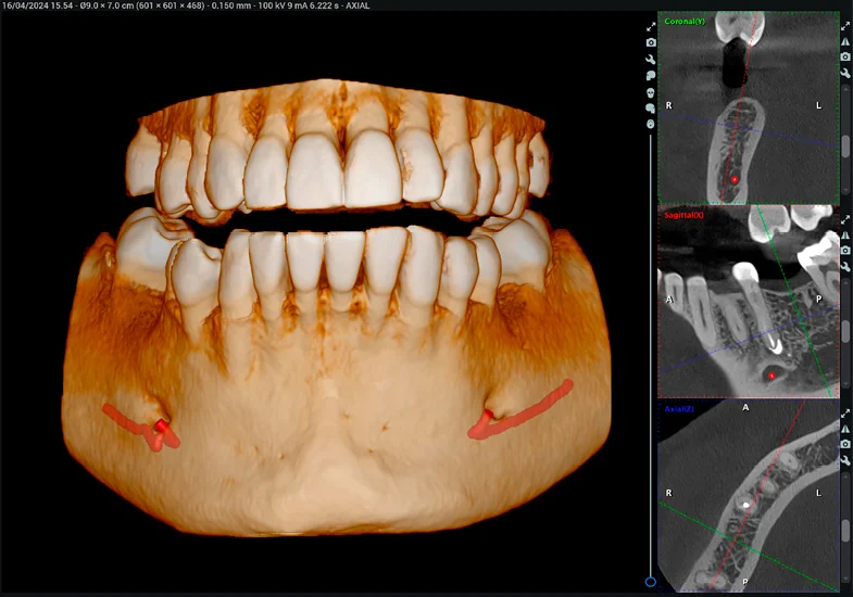 romexis-3d-implant-workflow-1.jpg